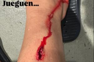 被林德洛夫出球后踹到小腿，毕尔巴鄂中场晒伤口：没红黄牌没犯规